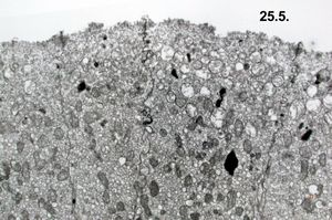 jejunum - celiakia